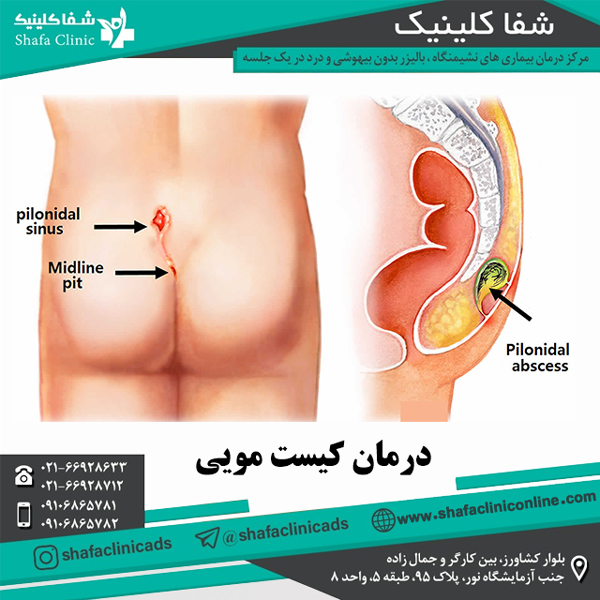 لیزر یسینوس پیلونیدال