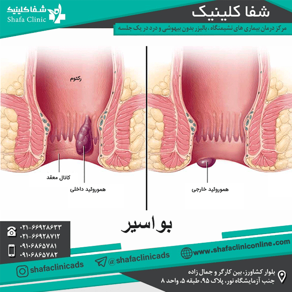بواسیر - شفا کلینیک