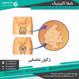 عکس زگیل تناسلی زنان و مردان