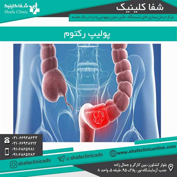 پولیپ رکتوم