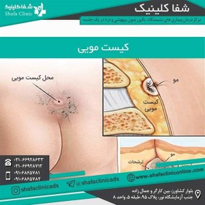 عکس کیست باسن