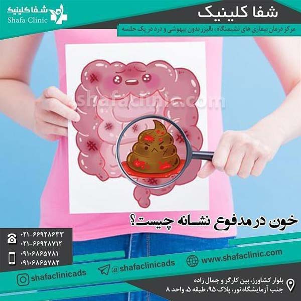 خون ریزی دستگاه گوارش