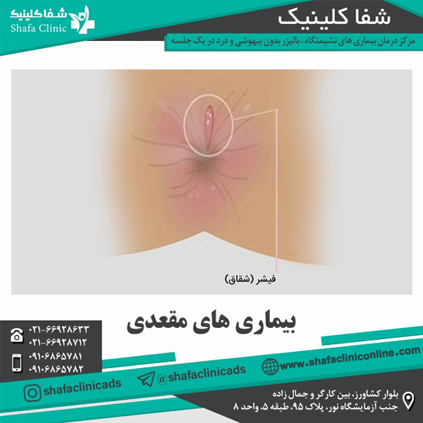 بیماری های مقعدی