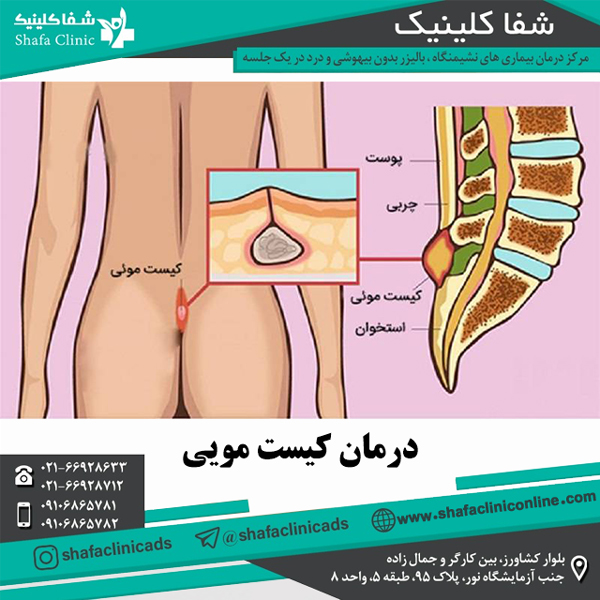 درمان کیست مویی