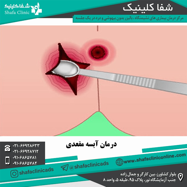 درمان آبسه مقعدی