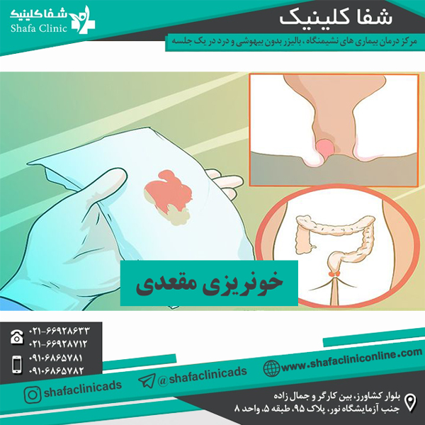 خونریزی مقعدی