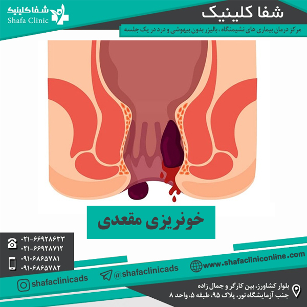 خونریزی مقعدی - شفا کلینیک