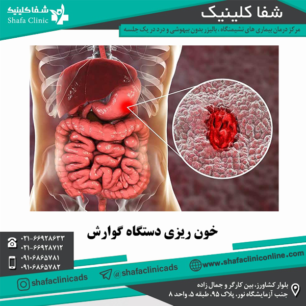 خون ریزی دستگاه گوارش