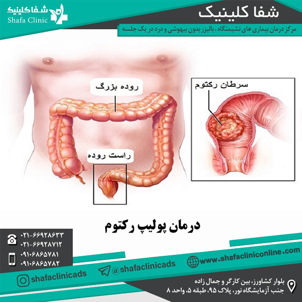 درمان پولیپ رکتوم