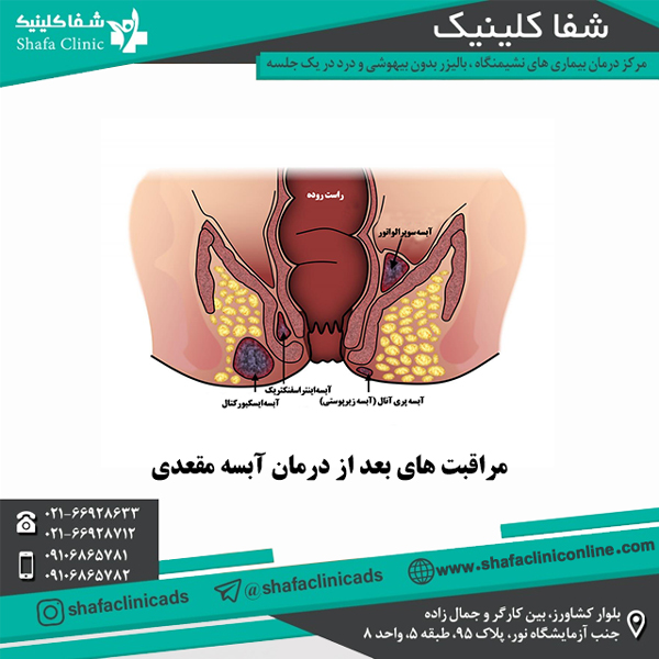 مراقبت های بعد از درمان آبسه مقعدی