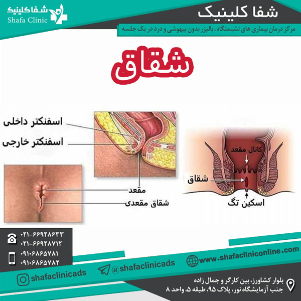 عکس شقاق مقعد