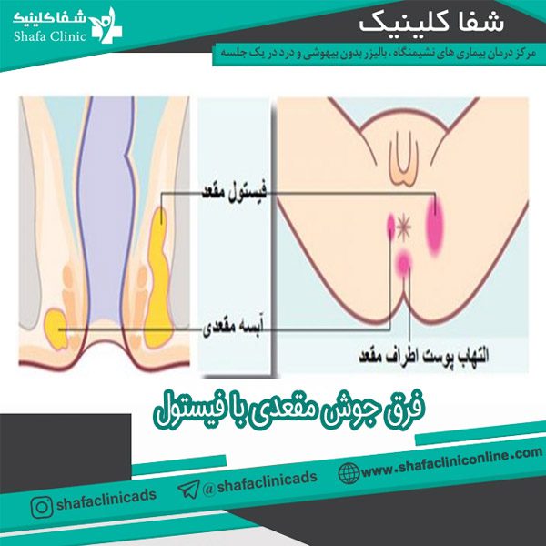 جوش مقعدی - شفا کلینیک