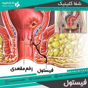 درمان فیستول + شفا کلینیک