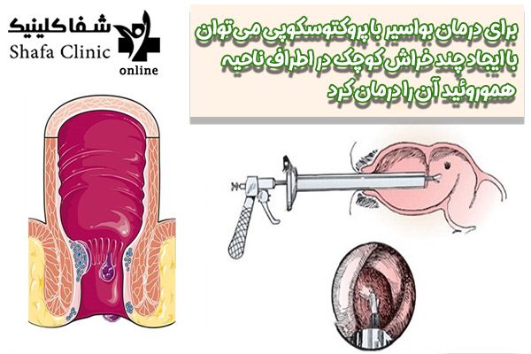 بواسیر - شفا کلینیک