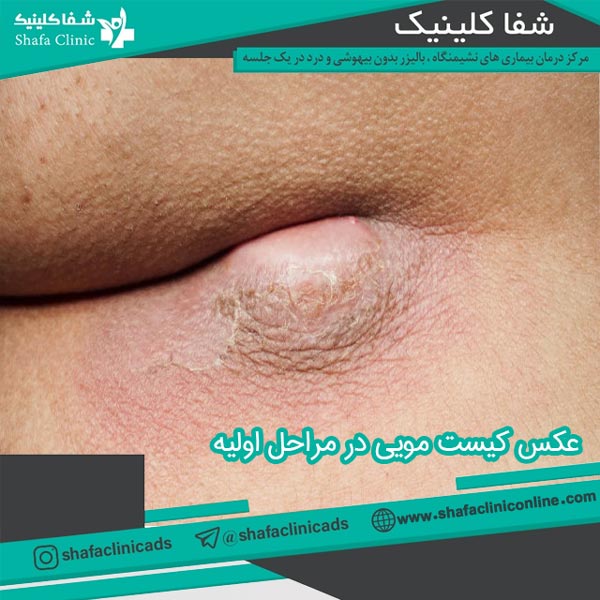 عکس کیست مویی در مراحل اولیه - شفا کلینیک