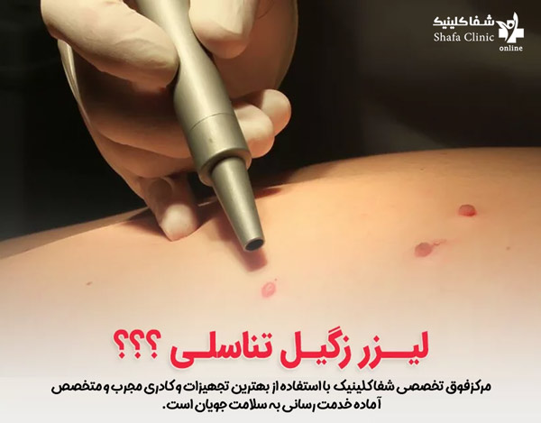 درمان زگیل تناسلی با لیزر - شفا کلینیک