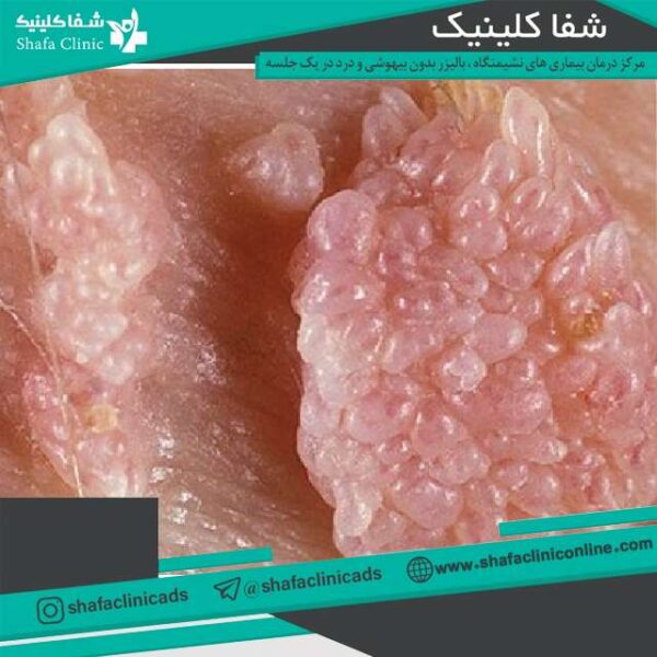 زگیل دختر مجرد