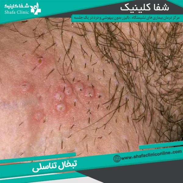 عکس تبخال تناسلی مردنان و زنان