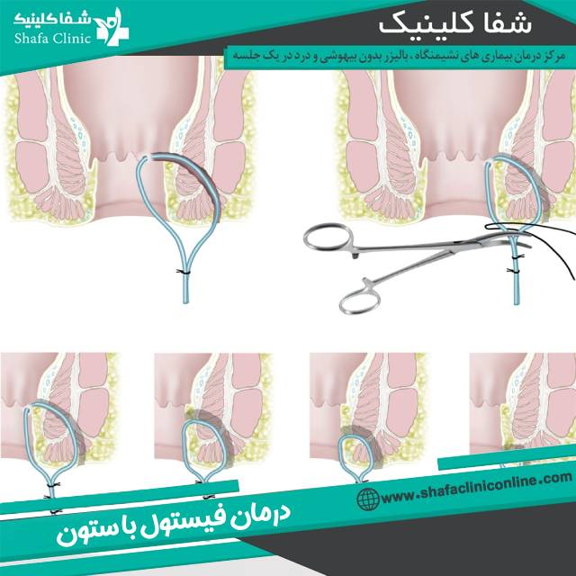 ستون برای درمان فیستول