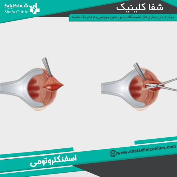 اسفنکتروتومی