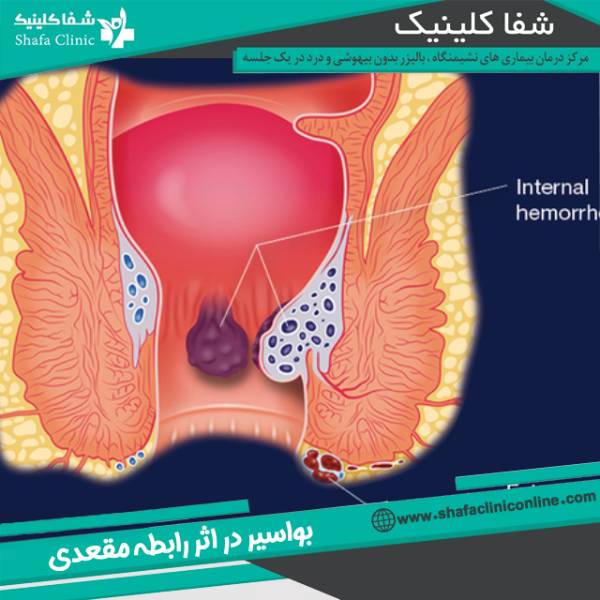 رابطه مقعدی و بواسیر
