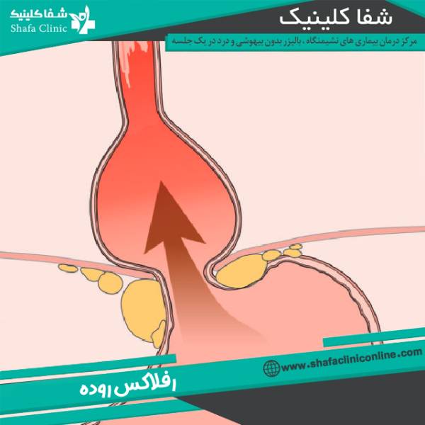 رفلاکس مدفوع