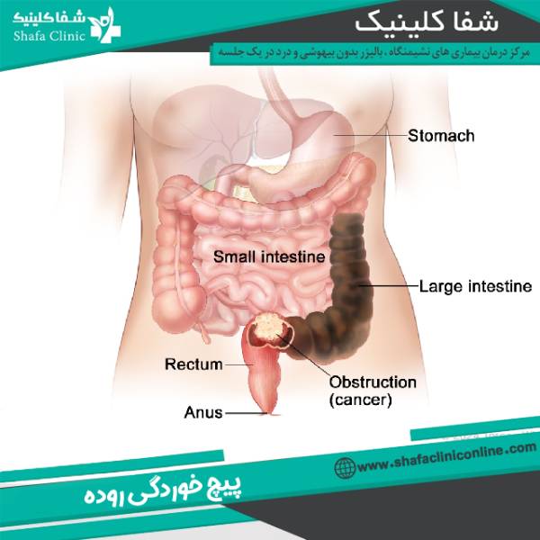 پیچ خوردگی روده