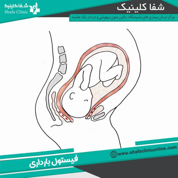 عکس فیستول بارداری