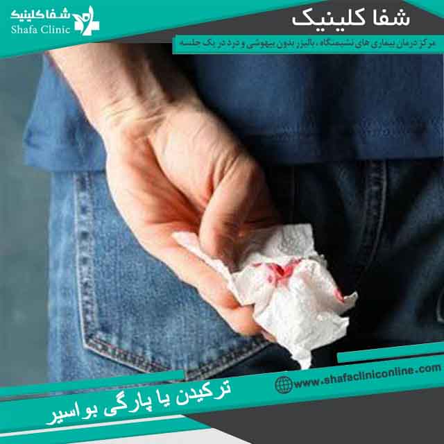 ترکیدن بواسیر یا هموروئید