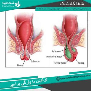 عکس پارگی هموروئید