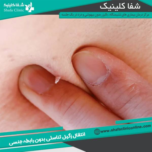 انتقال زگیل تناسلی بدون رابطه