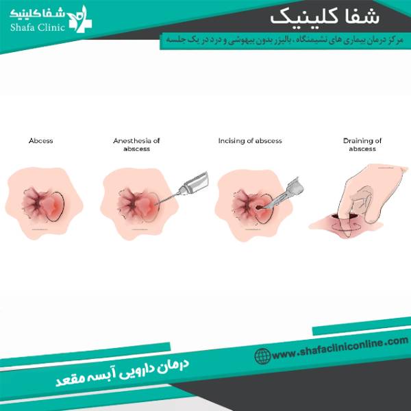 درمان دارویی آبسه مقعد