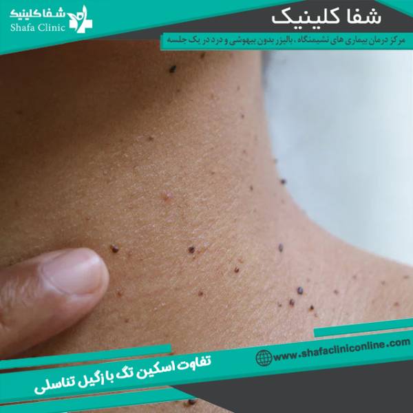 تفاوت اسکین تگ با زگیل تناسلی