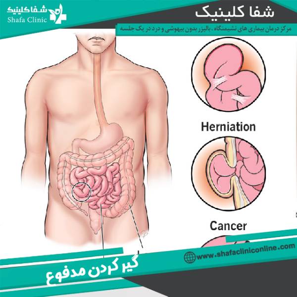 گیر کردن مدفوع