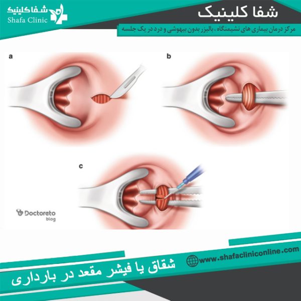 شقاق در بارداری