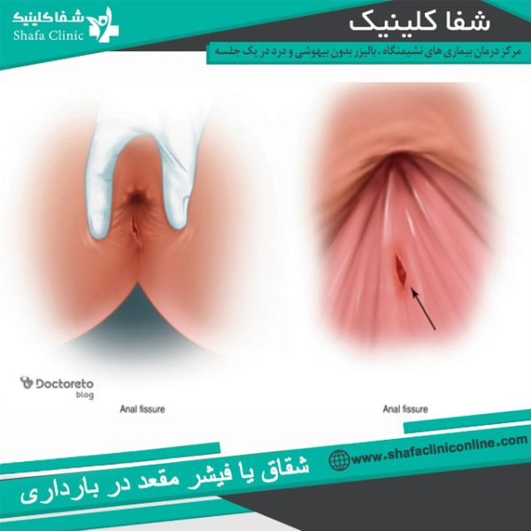 شقاق در بارداری