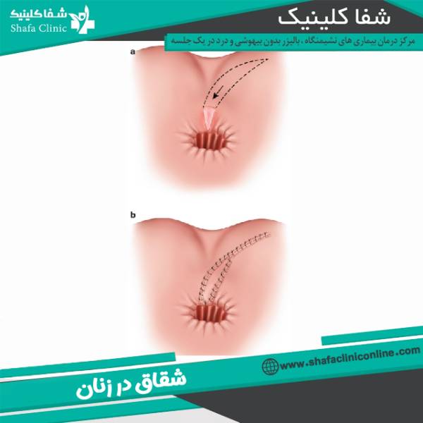 شقاق زنان